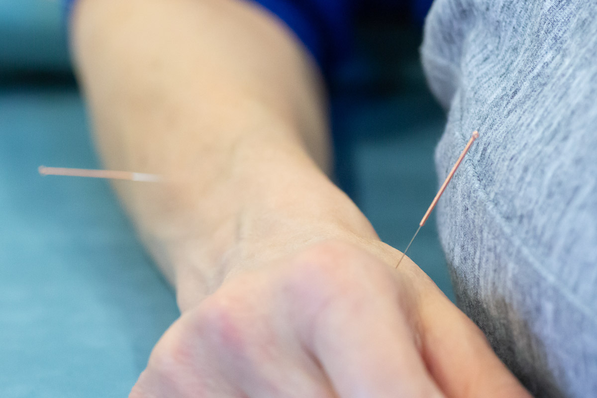 Acupuncture needles in hand